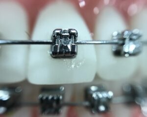 zoom, orthodontics, iphone
