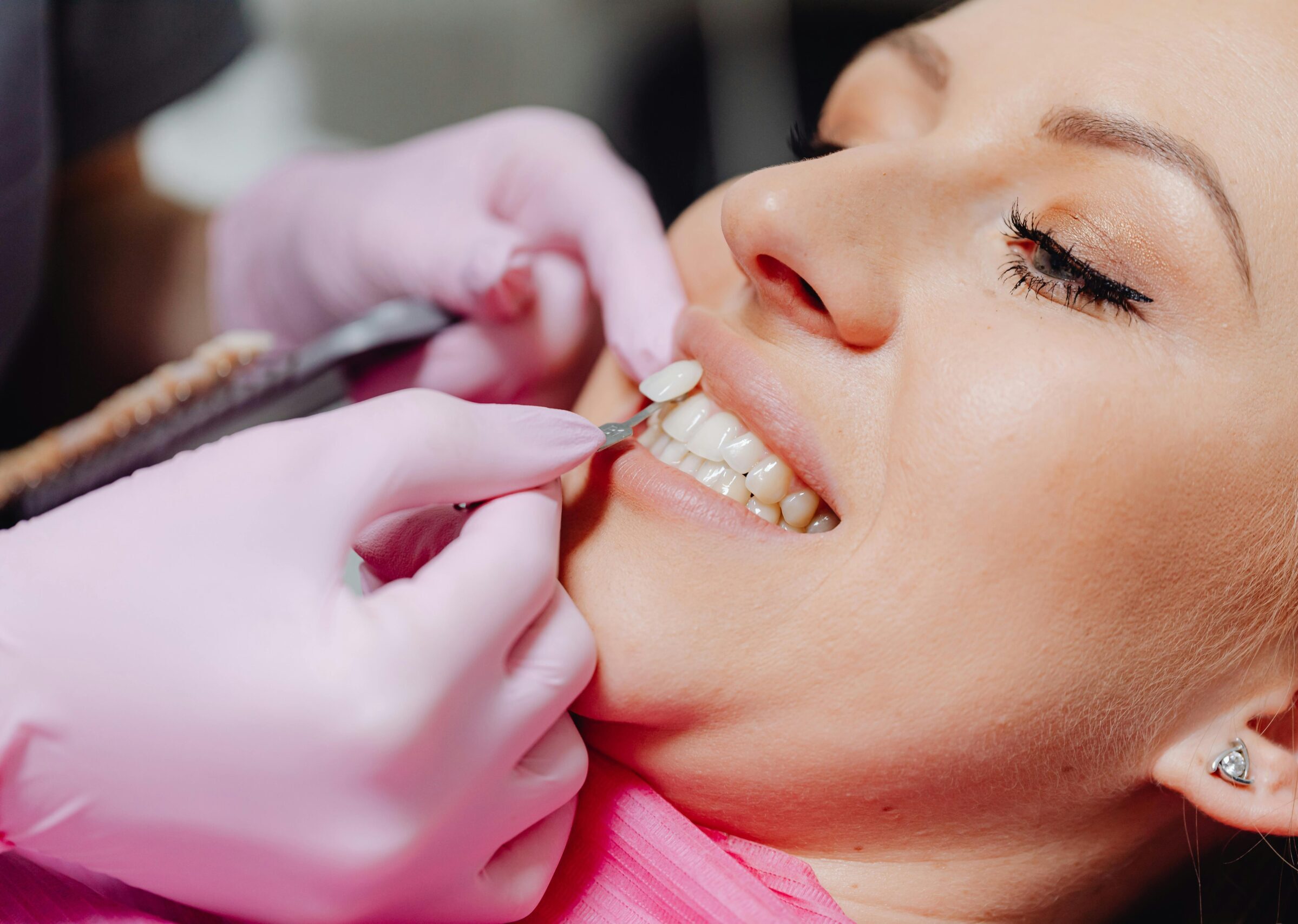 A close-up of a woman receiving dental veneers, showcasing detail and precision.